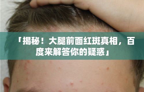 「揭秘！大腿前面紅斑真相，百度來解答你的疑惑」